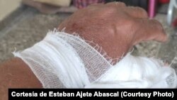 Esteban Ajete Abascal muestra la herida en la mano causada por el agresor, por la que tuvo que ser atendido en un hospital. 