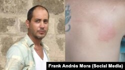 Frank Andrés Mora y la herida en su espalda causada por un asaltante. (Facebook).