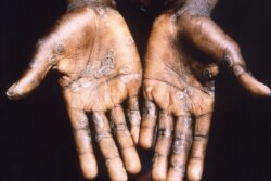 Las lesiones por viruela del mono suelen aparecer en las palmas de las manos. (Foto: CDC)