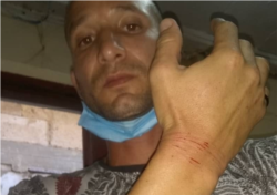 Omar Ortega muestra las heridas que le dejaron las esposas durante la detención.