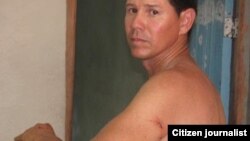 Reporta Cuba. Yoel Bencomo muestra golpes recibidos cuando tomaba fotos de una protesta.