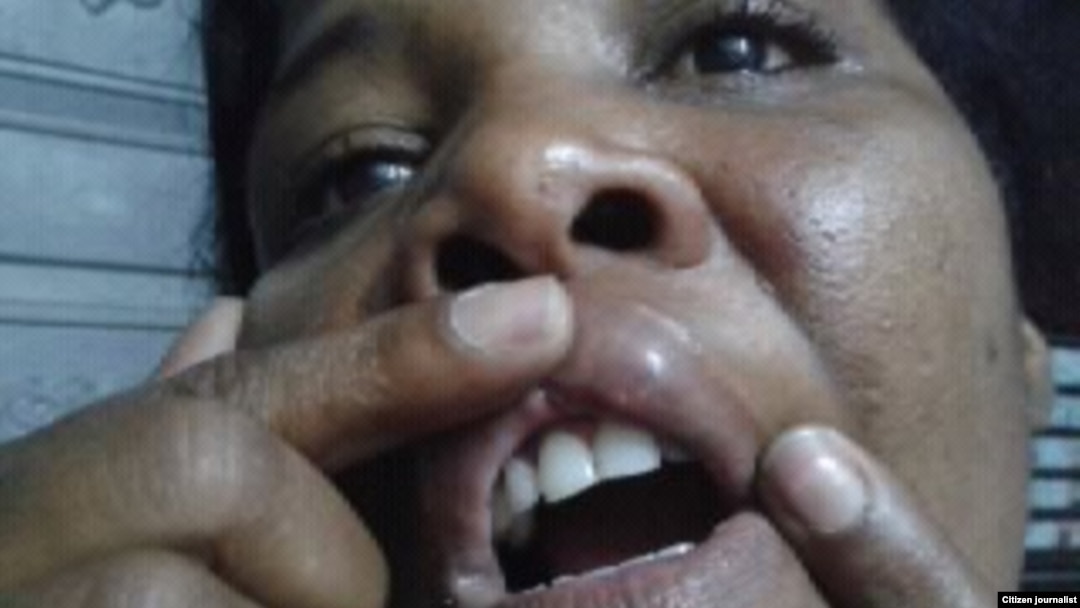 Yris Tamara Pérez, esposa de Antúnez,muestra las secuelas de una golpiza.