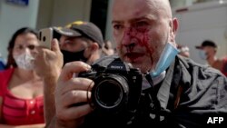 El fotógrafo de AP, el español Ramón Espinosa, aparece con heridas en la cara mientras cubría una manifestación contra el presidente cubano Miguel Díaz-Canel en La Habana, el 11 de julio de 2021.