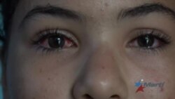 Cubanos sufren epidemia de conjuntivitis en medio de insalubridad y carencia de medicamentos