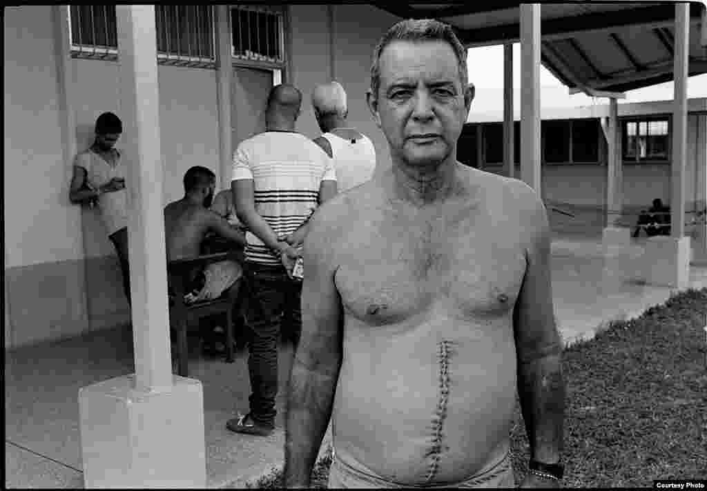 Un hombre muestra la herida de una cirugía reciente, atrapado por el lente del artista cubano Geandy Pavón en Costa Rica, lugar de los campamentos para migrantes cubanos.