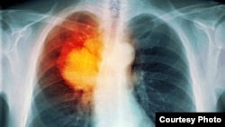 Radiografía de cáncer de pulmón. Esta localización es la de mayor incidencia en Cuba, con alto índice de fumadores.