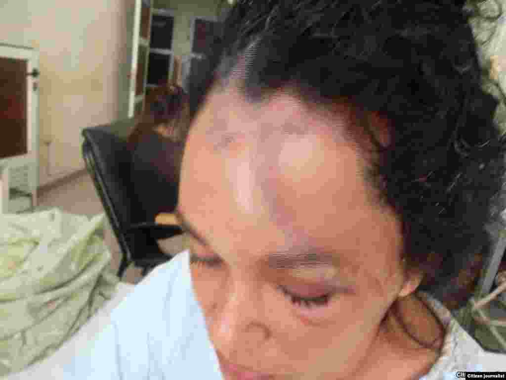 Bárbara Danay Canals Aramburo, también residente en la vivienda, tuvo que ser intervenida quirúrgicamente, dos veces, la madrugada del día 8 de febrero.
