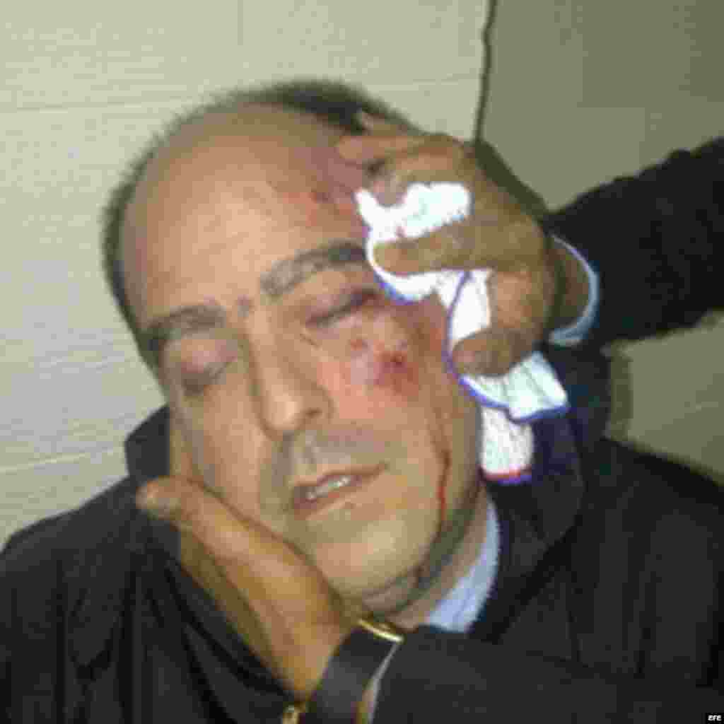  Fotografía cedida por el equipo de prensa del partido político venezolano "Primero Justicia" donde se observa al diputado opositor Julio Borges, ensangrentado, golpeado en un ojo y con el pómulo izquierdo visiblemente hinchado hoy, martes 30 de abril de 