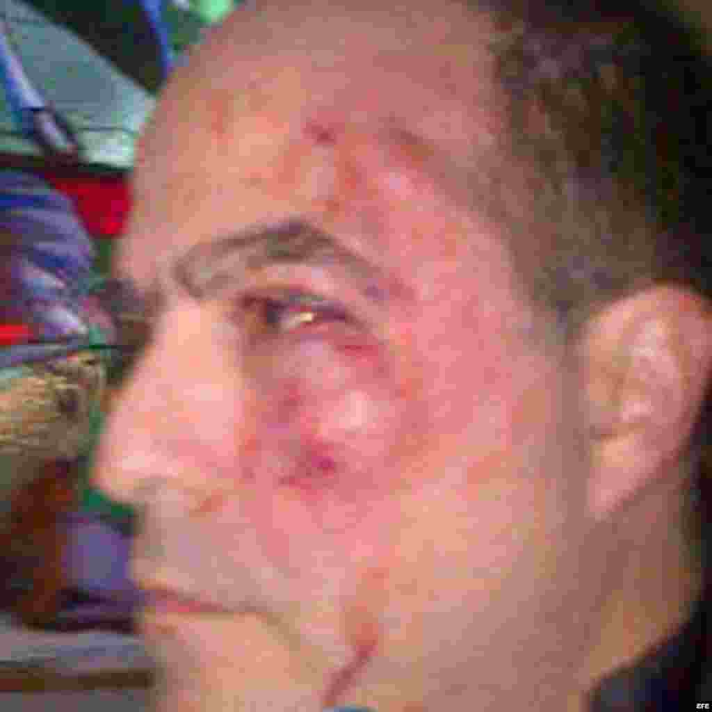  Fotografía cedida por el equipo de prensa del partido político venezolano "Primero Justicia" donde se observa al diputado opositor Julio Borges, ensangrentado, golpeado en un ojo y con el pómulo izquierdo visiblemente hinchado hoy, martes 30 de abril de 