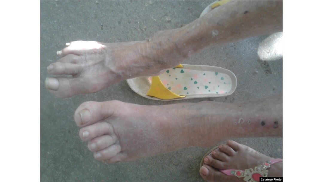 Vega de la Fe tiene en los pies y padece una cardiopatía