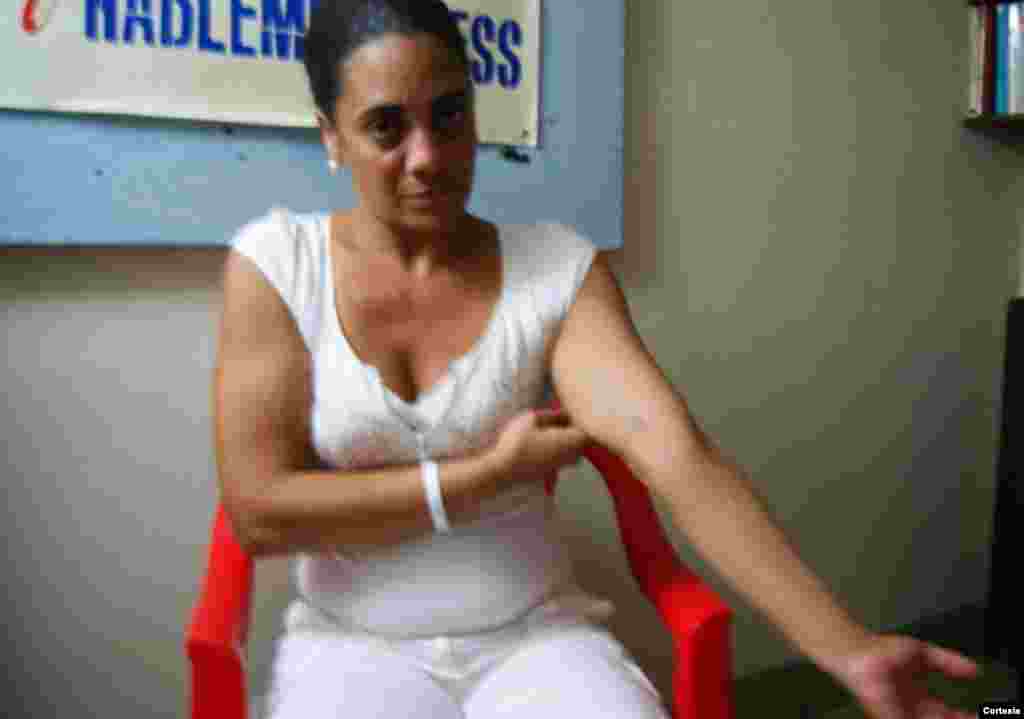 Dama de Blanco Tatiana L&oacute;pez, muestra da&ntilde;os ocasionados por la violencia policial al ser detenida