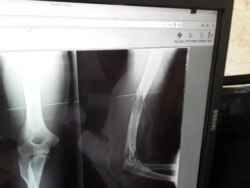 Imagen muestra la fractura sufrida por Pérez Carmenate. (Foto: Carlos Amel Oliva)