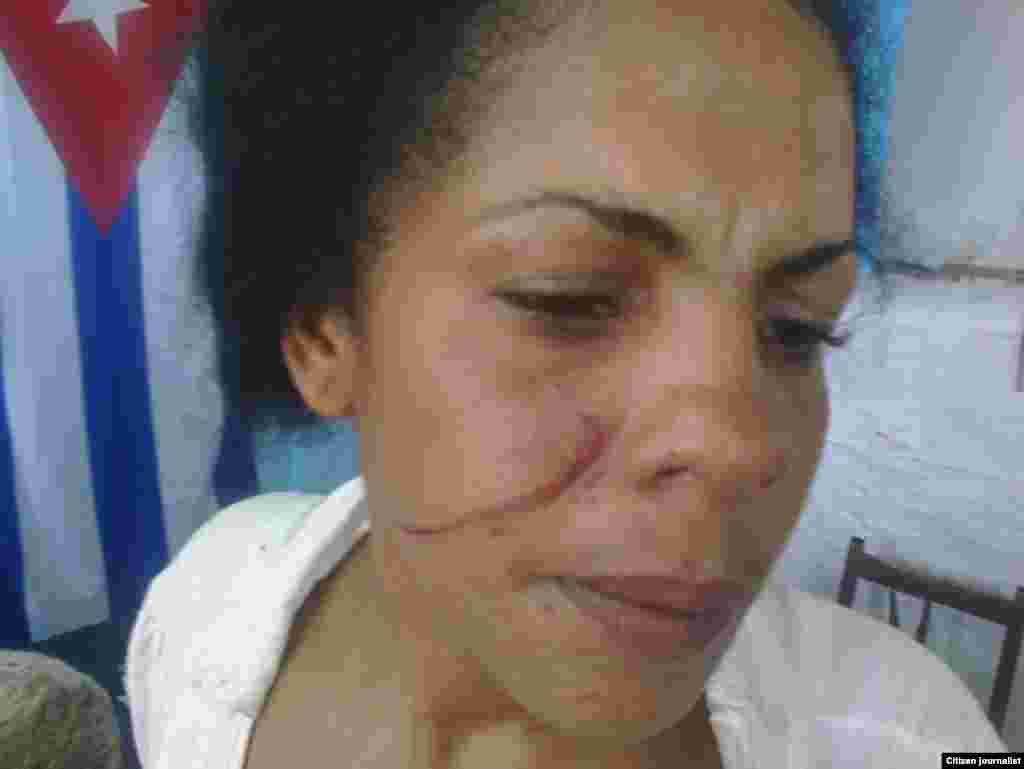 &nbsp;Yunaisi Carracedo, golpeada por la policía.