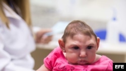 Una niña brasileña con microcefalia a causa del virus del zika. 