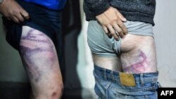 Manifestantes de Bielorrusia muestran las huellas de torturas recibidas durante arrestos