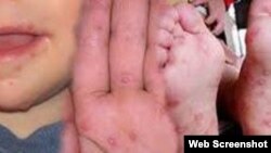 El virus boca-mano-pies afecta a menores de cinco años, pero no puede contagiar a adolescentes y adultos.