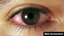 Ojo de paciente afectado de conjuntivitis.