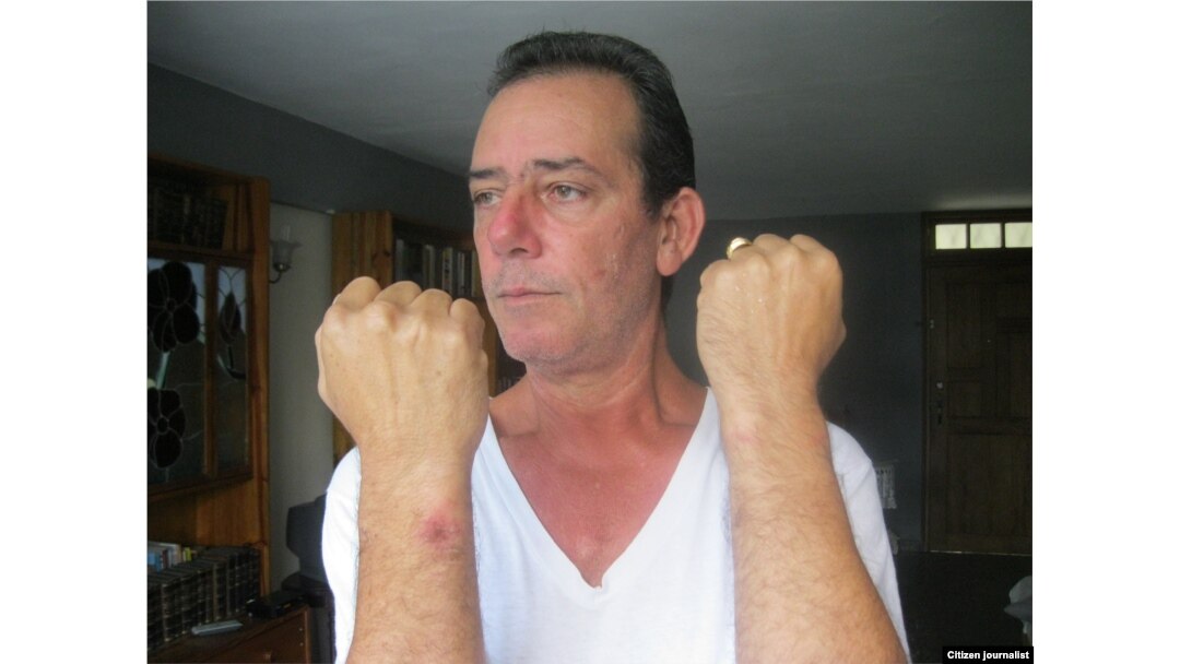 Lázaro Yuri Valle muestra los golpes que recibió el 10 de Diciembre de 2015. Reporta Cuba. Foto Enrique Díaz