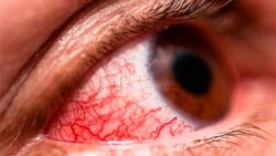 Brote de conjuntivitis en Las Tunas, afectados opinan