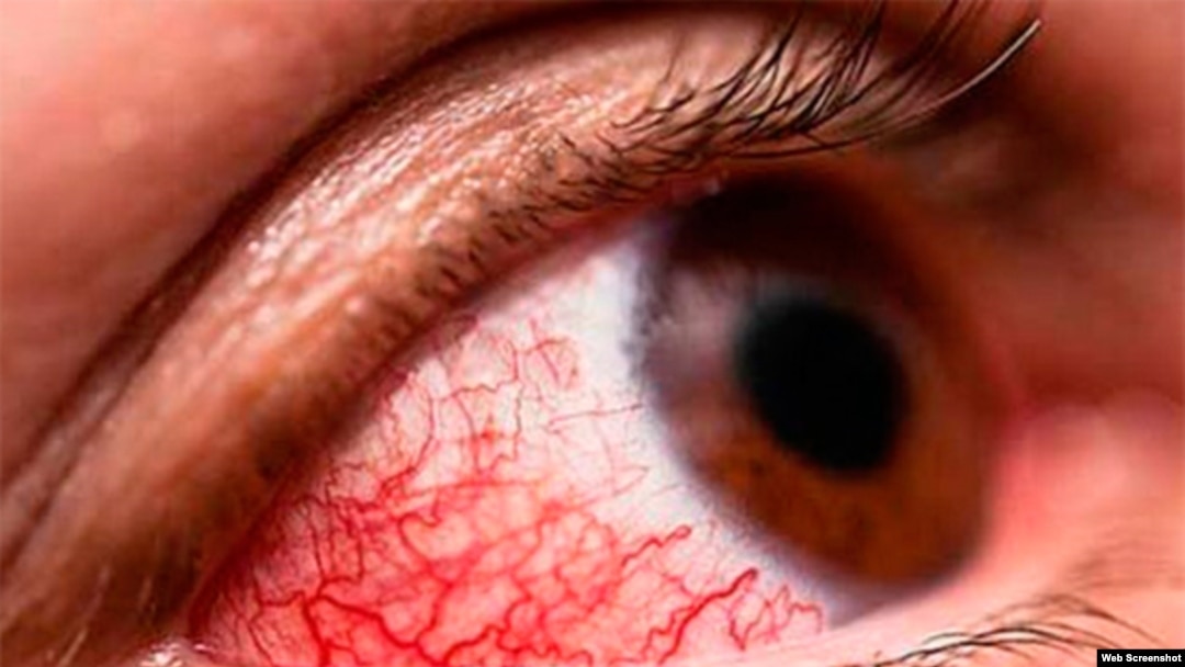 Conjuntivitis Hemorrágia Epidémica