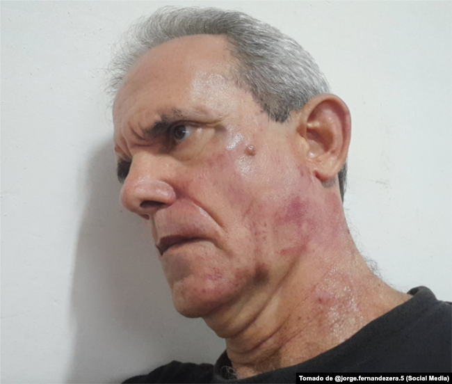 El rostro del escritor cubano Jorge Fernández Era mostrando moretones y lesiones tras la golpiza recibida en una estación de policía en La Habana.