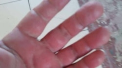 Las secuelas de los virus en Cuba: testimonios